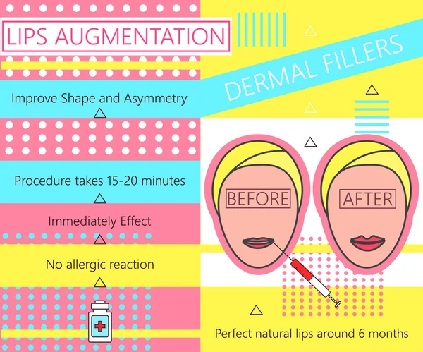 Infographie sur l'augmentation des lèvres. Remplisseurs dermiques. La cosmétologie. La beauté. Illustration vectorielle . — Image vectorielle