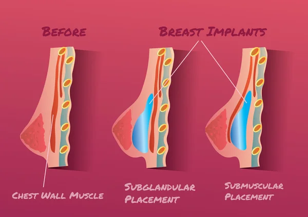 유 방 임 플 란 트 벡터 일러스트 레이 션 infographic 전후 — 스톡 벡터