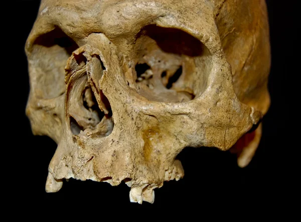 Velho crânio humano sem mandíbula — Fotografia de Stock