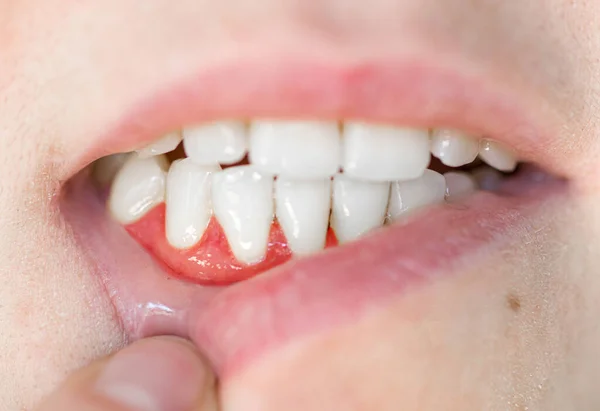 Dişlere yakın çekim. Bir kadında sakız hastalığı, periodontal hastalık. tartar temizleme, diş tedavisi