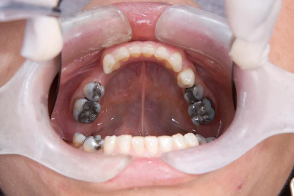 制造过程的假牙 — 图库照片