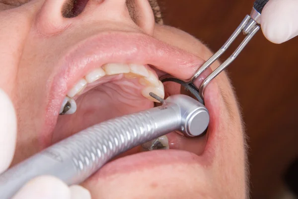 Manufacturing process of dental prostheses — Stock Photo, Image