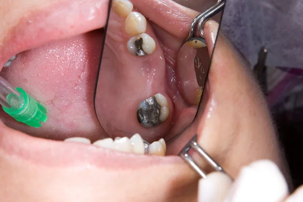 Manufacturing process of dental prostheses — Stock Photo, Image