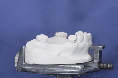 manufacturing process of dental prostheses clipart