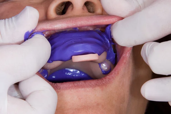 歯科補綴物の製造工程 — ストック写真