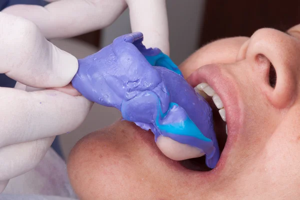 Proces produkcji protez dentystycznych — Zdjęcie stockowe