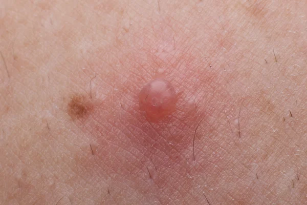 Su çiçeği enfeksiyonundan kaynaklanan su kabarcığı .