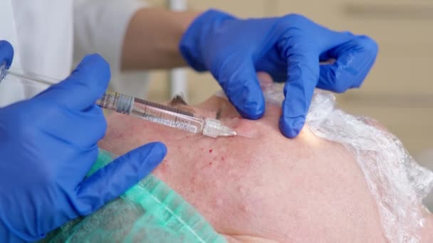 Arts injecteren hyaluronzuur in de rijpe huid tijdens biorevitalisatie procedure, close-up — Stockvideo