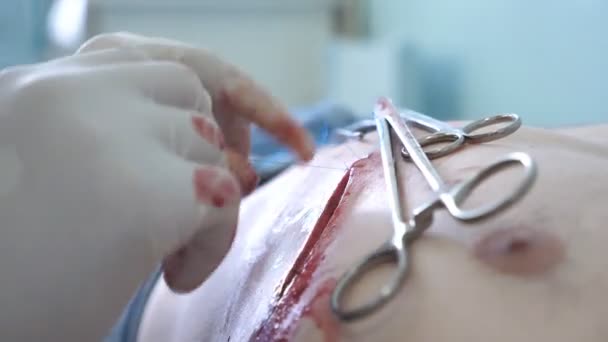 Les bras du médecin dans les gants cousant la blessure. Sutures de plaies par chirurgien. Gros plan — Video