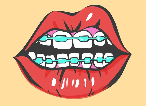 Pop Art Sexy Lips With Dental Braces. Vector Object — 图库矢量图片