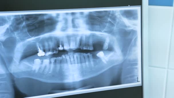 X-ray image of teeth — Stock Video