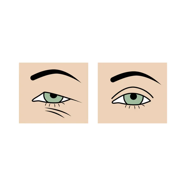 Övre Ögonlocket Blefaroplastik Före Och Efter Jämförelse Hängande Ögonlock Och — Stock vektor