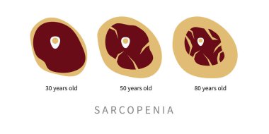 Sarcopenia in elderly. Replacement of muscle tissue with fat in aging process. Vector illustration clipart