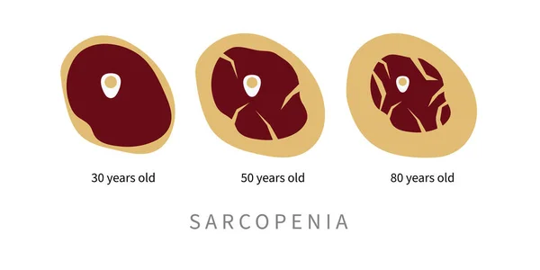 Sarcopenia 'da yaşlılar için. Yaşlanma sürecinde kas dokusunun yağ ile değiştirilmesi. Vektör illüstrasyonu