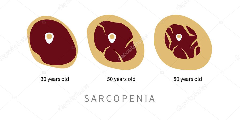 Sarcopenia in elderly. Replacement of muscle tissue with fat in aging process. Vector illustration
