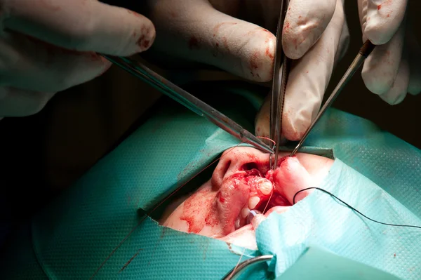 Oroszország - 2012. szeptember 10.: plasztikai sebészet ajak moith és nouse — Stock Fotó