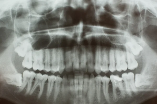 X 線の歯 — ストック写真