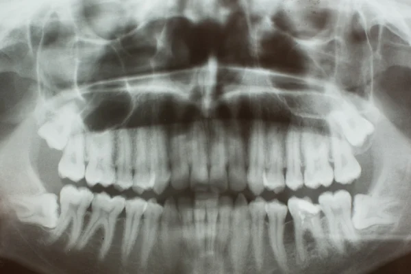 RTG zębów — Zdjęcie stockowe