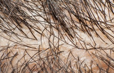 Kepek saç derisi ve siyah saçlı. Makro çekim