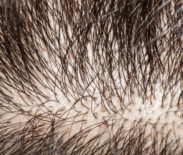 Closeup head with hair and scalp — Stock Photo, Image