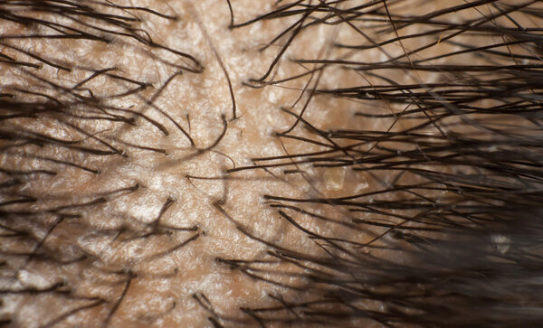 Перхоть на голове и темные волосы. Макро выстрел
