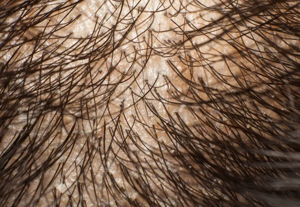 Dandruff on scalp and dark hair. Macro shot — Stock Photo, Image