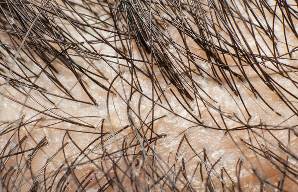 Перхоть на голове и темные волосы. Макро выстрел
