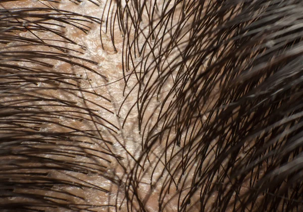 Dandruff on scalp and dark hair. Macro shot — Stock Photo, Image