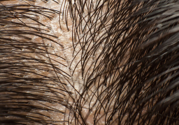 Перхоть на голове и темные волосы. Макро выстрел
