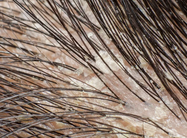 Dandruff di rambut dan kulit kepala. Tembakkan makro . — Stok Foto