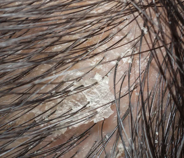 Dandruff in the hair and scalp. Macro shot. — Stock Photo, Image