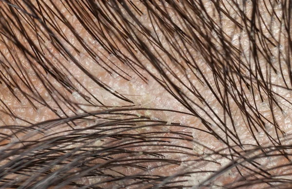 Dandruff in the hair and scalp. Macro shot. — Stock Photo, Image