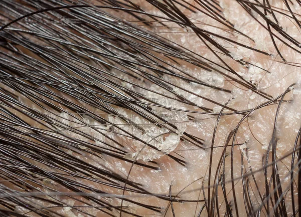 Dandruff in the hair and scalp. Macro shot. — Stock Photo, Image