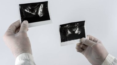 Doktorun elinde prostat resmi, beyaz arka planda prostat ultrasonu.