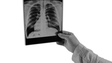 Beyazın üzerinde izole edilmiş insan ciğerlerinin röntgeni, doktorun ellerinde akciğerlerin bir resmi, zatürree.