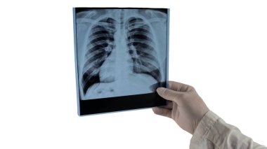 İnsan ciğerlerinin röntgeni beyaza izole edilmiş, akciğerlerin resmi, akciğerlerin ultra görüntüsü yakından çekilmiş.