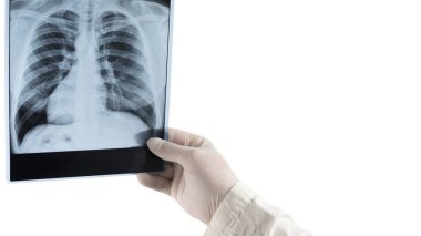 Ciğerlerin röntgenleri beyaz alanda izole edilmiş. Metin, yakın çekim, insan akciğerlerinin görüntüsü. Doktor akciğerlerin resmini analiz ediyor.