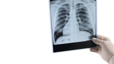 Ciğerlerin X-ray 'i ve yazı için yeri var. Ciğerlerin resmi beyaza izole edilmiş.