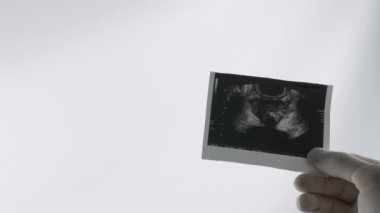 Prostatın ultrasonu beyaz bir arkaplanda. Prostatın resmi.