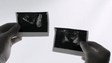 Beyaz arka planda prostatın ultrasonu, bir doktorun elinde bir erkek prostatın resmi..
