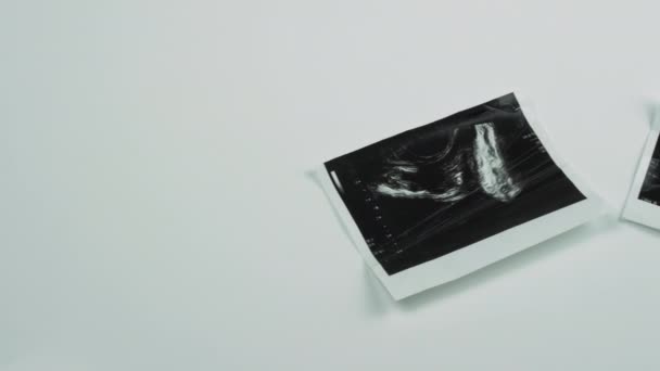 Ultrasound Dari Prostat Pria Dengan Latar Belakang Putih Gambar Prostat — Stok Video