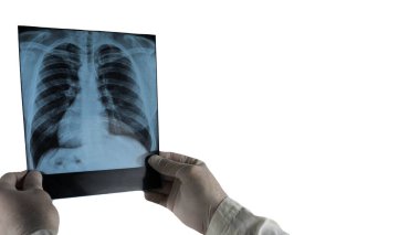 İnsan ciğerlerinin röntgeni beyaza izole edilmiş.