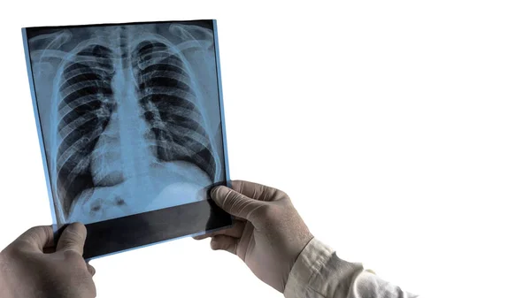 Menneskelige Lunger Ray Isoleret Hvid Læge Undersøger Lunger Ray Lungebetændelse - Stock-foto