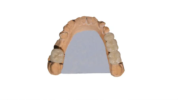 Ceramiczna Korona Zęba Gipsowym Modelu Zębów Białym Izolowanym Tle Praca — Zdjęcie stockowe
