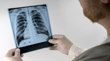 Resimde sağlıklı bir insanın akciğerleri, bir doktorun elinde bir insanın akciğerlerinin röntgeni, bir tıp çalışanı röntgen ve zatürree analizi yapar..