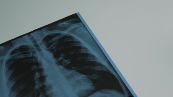 临床X光照片 呼吸道疾病药物 流感药物注射器 肺气肿 2021年1月2日 — 图库视频影像