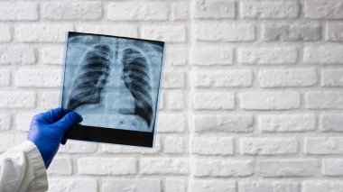 X-ray of the human chest in the hands of a doctor, X-ray of the lungs. The doctor diagnoses pneumonia of the lungs. A doctor checks a chest x-ray film in a hospital