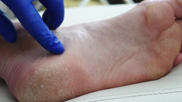 Médecin Diagnostique Pied Blessé Peau Sèche Psoriasis Des Pieds Peau — Video