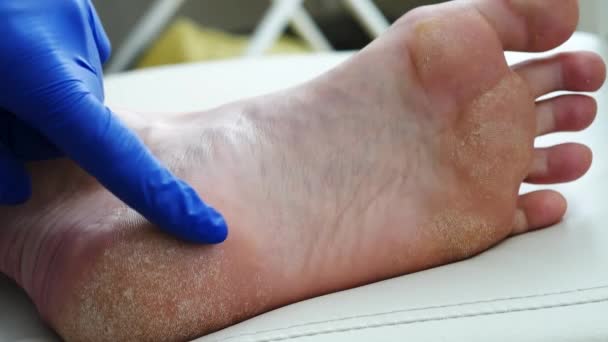 Человеческая Нога Сухой Кожей Сухая Кожа Псориаз Ног Кожа Повреждена — стоковое видео