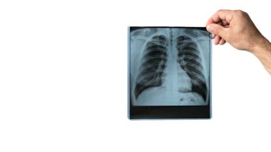 Zatürree fotoğrafının uzay analizini kopyala. Doktor klinikteki akciğerlerin röntgenine bakar, sağlık görevlisi akciğerlerin zatürreesini analiz eder. Solunum enfeksiyonu